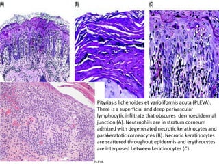 Pityriasis lichenoides et varioliformis acuta (PLEVA).
There is a superﬁcial and deep perivascular
lymphocytic inﬁltrate that obscures dermoepidermal
junction (A). Neutrophils are in stratum corneum
admixed with degenerated necrotic keratinocytes and
parakeratotic corneocytes (B). Necrotic keratinocytes
are scattered throughout epidermis and erythrocytes
are interposed between keratinocytes (C).

 