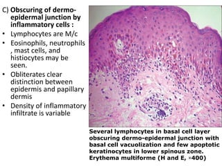 C) Obscuring of dermoepidermal junction by
inflammatory cells :
• Lymphocytes are M/c
• Eosinophils, neutrophils
, mast cells, and
histiocytes may be
seen.
• Obliterates clear
distinction between
epidermis and papillary
dermis
• Density of inflammatory
infiltrate is variable
Several lymphocytes in basal cell layer
obscuring dermo-epidermal junction with
basal cell vacuolization and few apoptotic
keratinocytes in lower spinous zone.
Erythema multiforme (H and E, ×400)

 