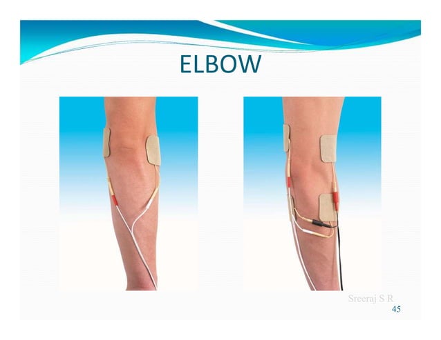 Interferential therapy | PDF | Physical Therapy | Wellness