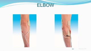 Sreeraj S R
ELBOW
44
 