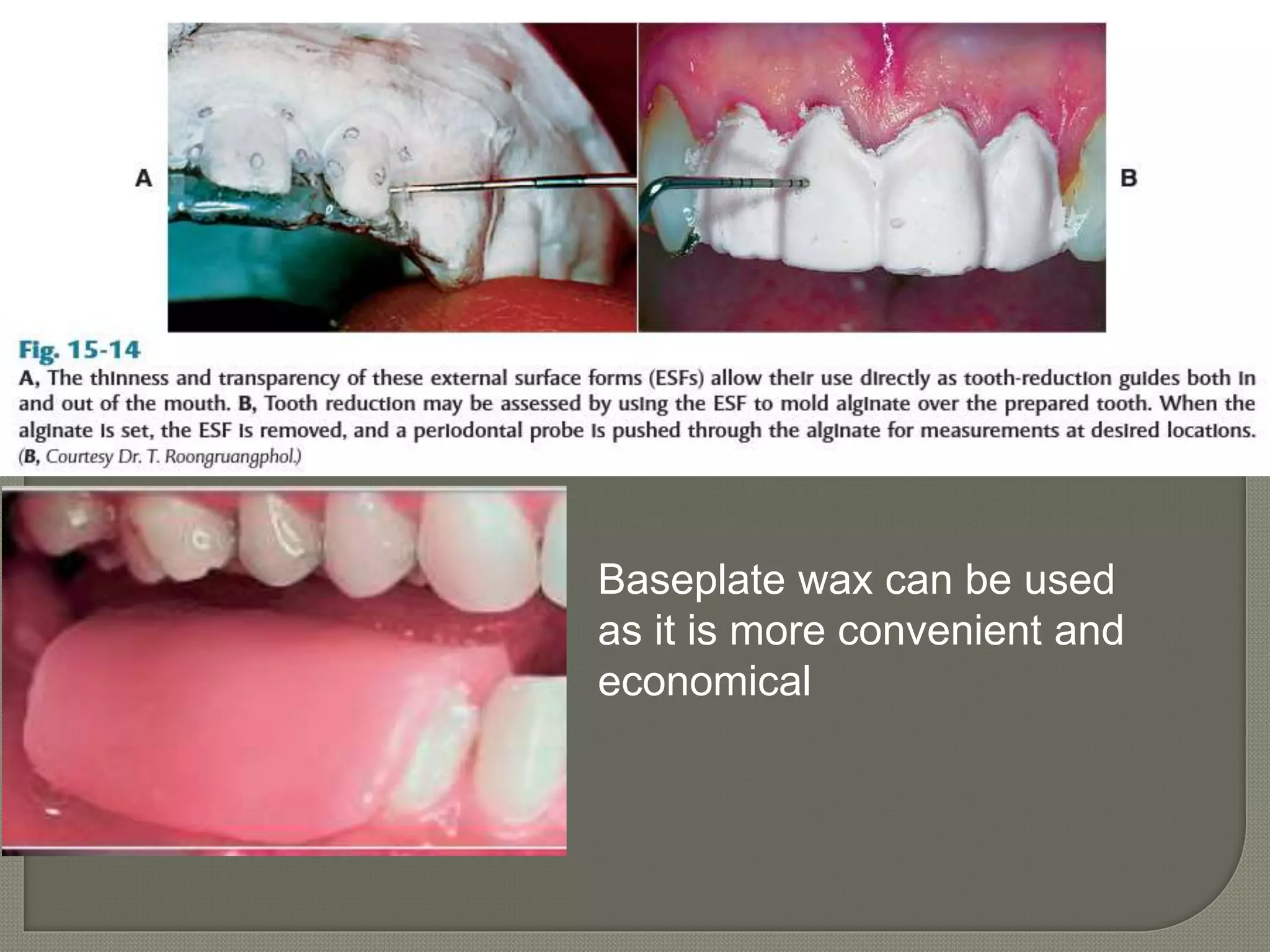 Baseplate wax can be used
as it is more convenient and
economical
 