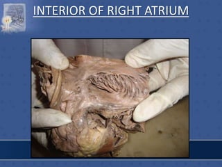 INTERIOR OF RIGHT ATRIUM
 