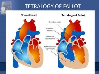 TETRALOGY OF FALLOT
 