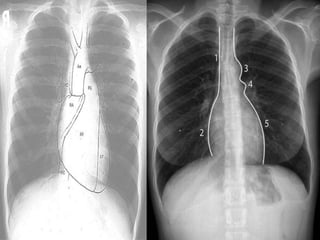 Interior of right atrium