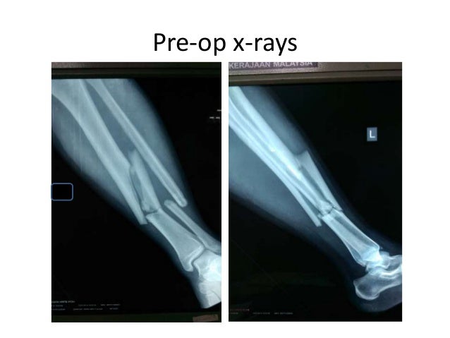 Interlocking Nail Of Tibia - 
