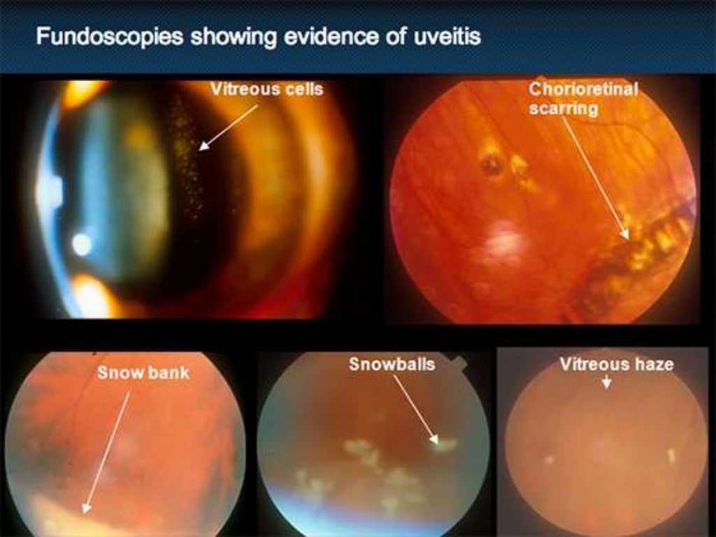 Intermediate uveitis