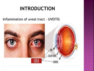 INTRODUCTION
Inflammation of uveal tract – UVEITIS
 