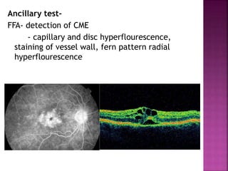Ancillary test-
FFA- detection of CME
- capillary and disc hyperflourescence,
staining of vessel wall, fern pattern radial
hyperflourescence
 
