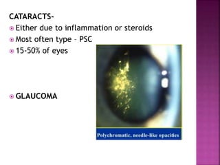 CATARACTS-
 Either due to inflammation or steroids
 Most often type – PSC
 15-50% of eyes
 GLAUCOMA
 