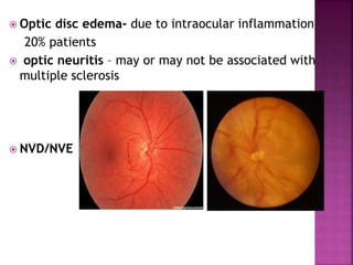  Optic disc edema- due to intraocular inflammation
20% patients
 optic neuritis – may or may not be associated with
multiple sclerosis
 NVD/NVE
 
