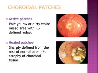 Active patches
Pale yellow or dirty white
raised area with ill-
defined edge.
 Healed patches-
Sharply defined from the
rest of normal area d/t
atrophy of choroidal
tissue
 