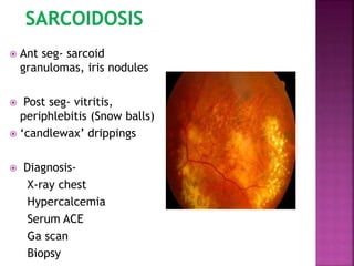  Ant seg- sarcoid
granulomas, iris nodules
 Post seg- vitritis,
periphlebitis (Snow balls)
 ‘candlewax’ drippings
 Diagnosis-
X-ray chest
Hypercalcemia
Serum ACE
Ga scan
Biopsy
 