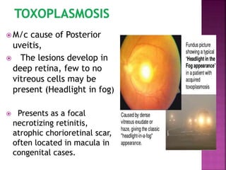  M/c cause of Posterior
uveitis,
 The lesions develop in
deep retina, few to no
vitreous cells may be
present (Headlight in fog)
 Presents as a focal
necrotizing retinitis,
atrophic chorioretinal scar,
often located in macula in
congenital cases.
 