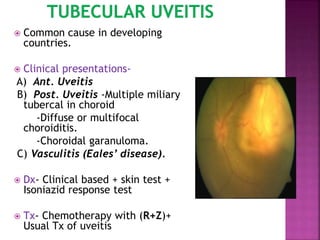  Common cause in developing
countries.
 Clinical presentations-
A) Ant. Uveitis
B) Post. Uveitis -Multiple miliary
tubercal in choroid
-Diffuse or multifocal
choroiditis.
-Choroidal garanuloma.
C) Vasculitis (Eales’ disease).
 Dx- Clinical based + skin test +
Isoniazid response test
 Tx- Chemotherapy with (R+Z)+
Usual Tx of uveitis
 