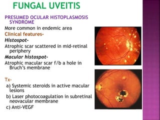 PRESUMED OCULAR HISTOPLASMOSIS
SYNDROME
More common in endemic area
Clinical features-
Histospot-
Atrophic scar scattered in mid-retinal
periphery
Macular histospot-
Atrophic macular scar f/b a hole in
Bruch’s membrane
Tx-
a) Systemic steroids in active macular
lesions
b) Laser photocoagulation in subretinal
neovacular membrane
c) Anti-VEGF
 