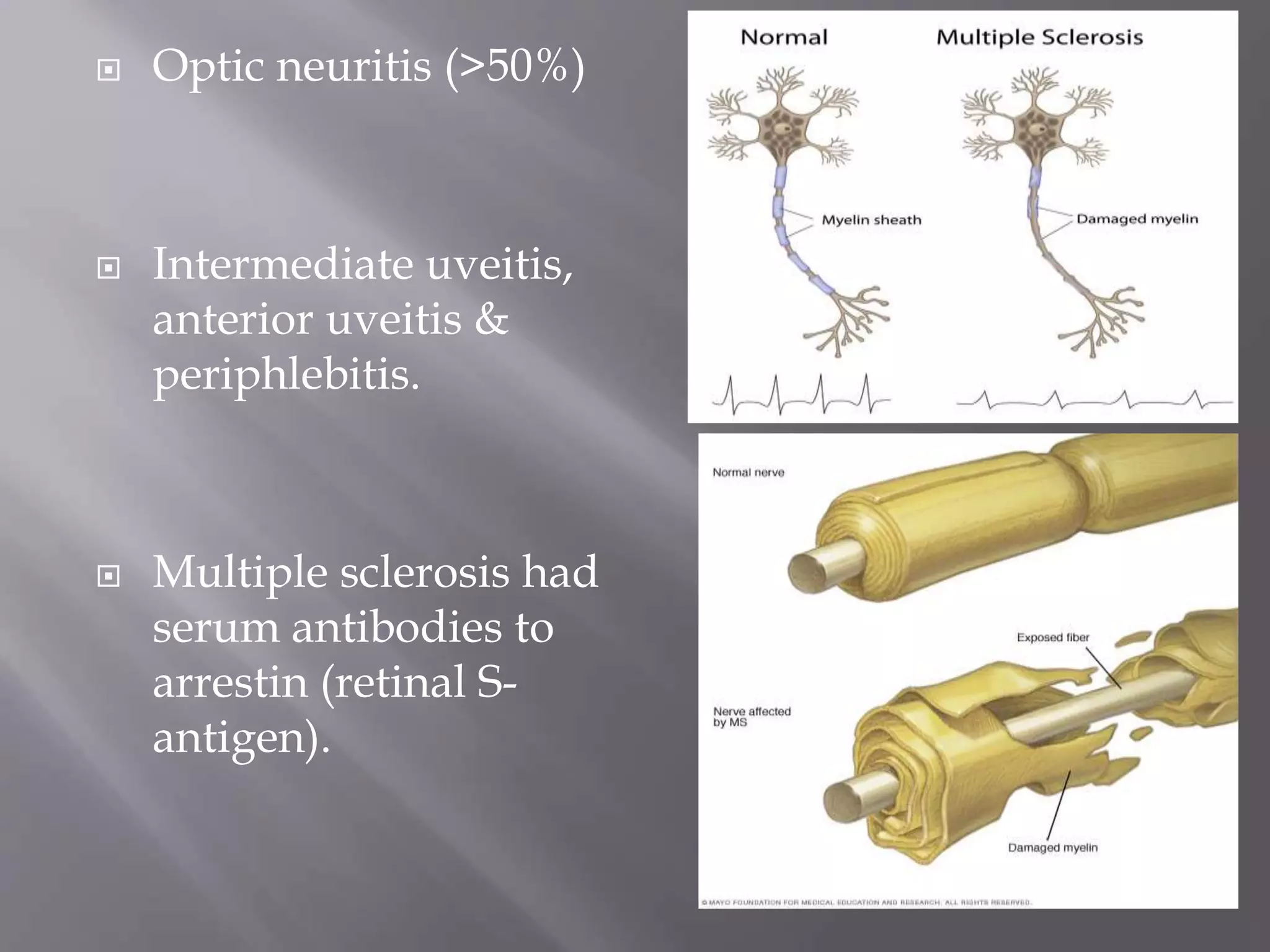  Optic neuritis (>50%)
 Intermediate uveitis,
anterior uveitis &
periphlebitis.
 Multiple sclerosis had
serum antibodies to
arrestin (retinal S-
antigen).
 