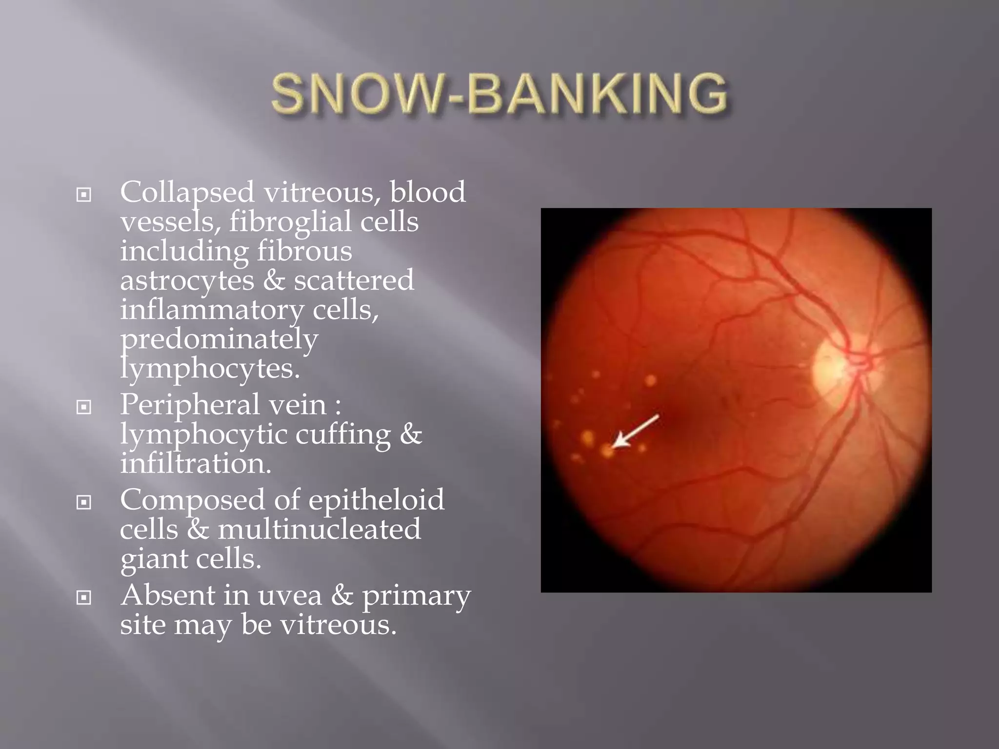  Collapsed vitreous, blood
vessels, fibroglial cells
including fibrous
astrocytes & scattered
inflammatory cells,
predominately
lymphocytes.
 Peripheral vein :
lymphocytic cuffing &
infiltration.
 Composed of epitheloid
cells & multinucleated
giant cells.
 Absent in uvea & primary
site may be vitreous.
 
