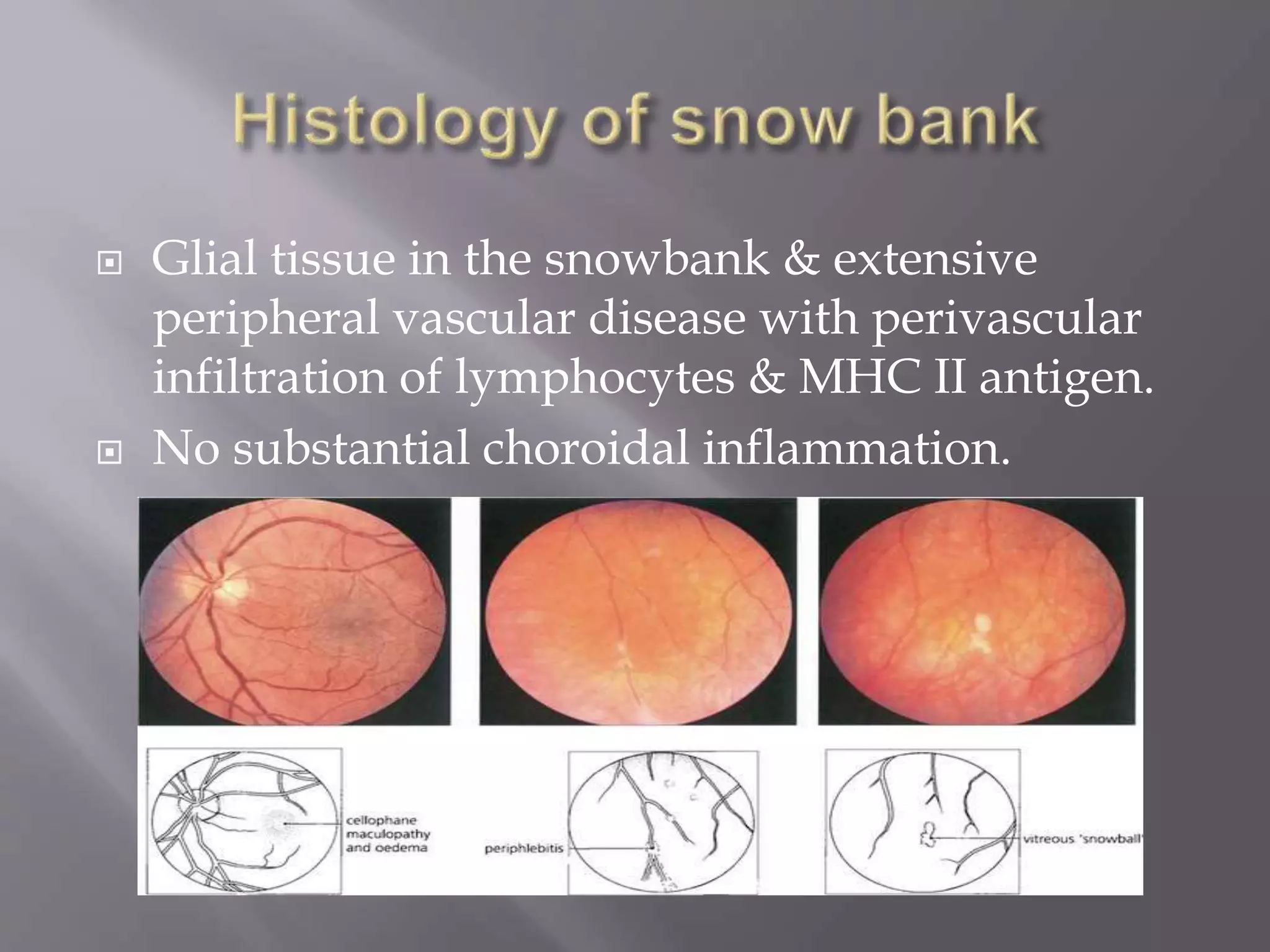  Glial tissue in the snowbank & extensive
peripheral vascular disease with perivascular
infiltration of lymphocytes & MHC II antigen.
 No substantial choroidal inflammation.
 