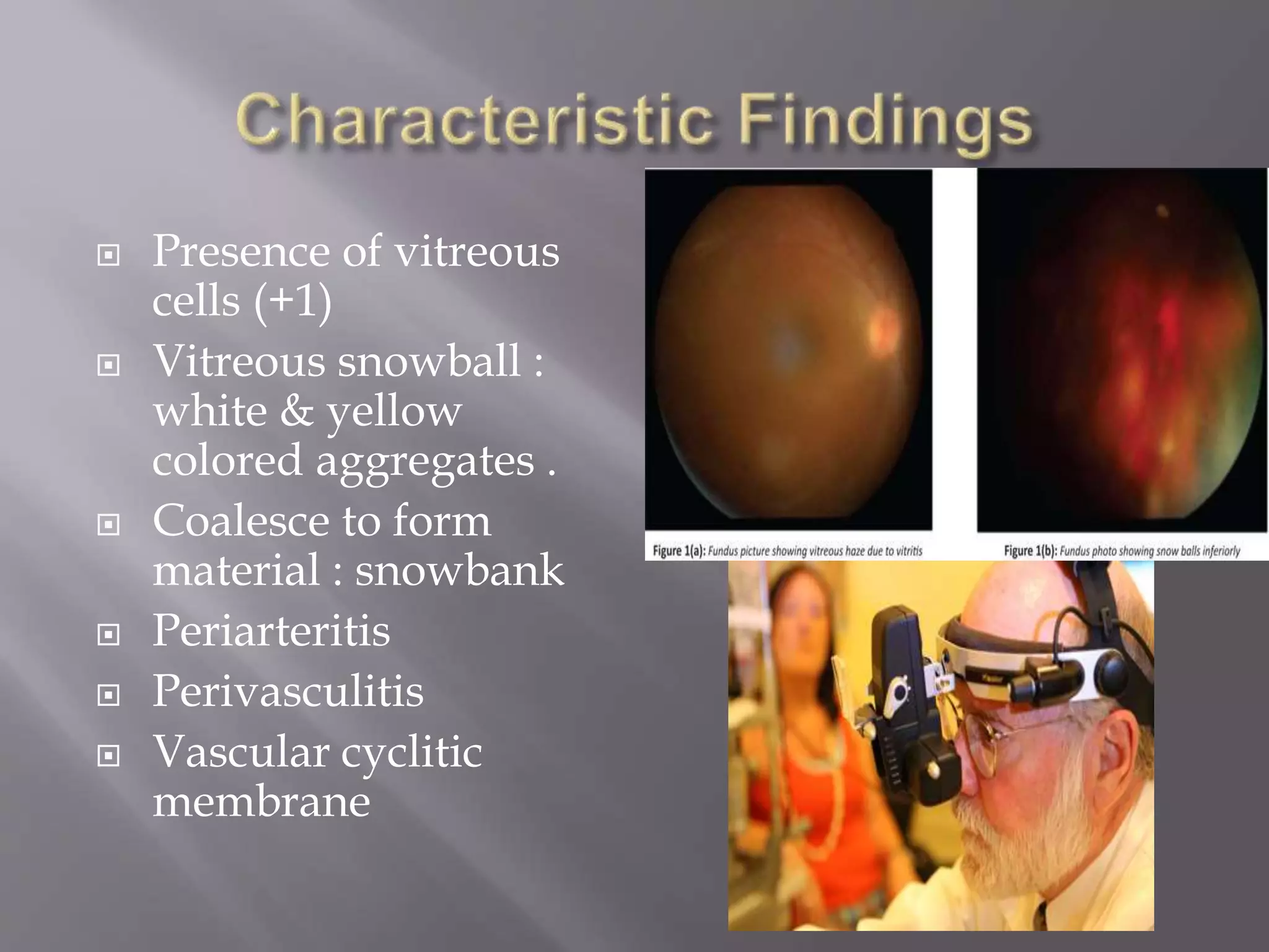  Presence of vitreous
cells (+1)
 Vitreous snowball :
white & yellow
colored aggregates .
 Coalesce to form
material : snowbank
 Periarteritis
 Perivasculitis
 Vascular cyclitic
membrane
 