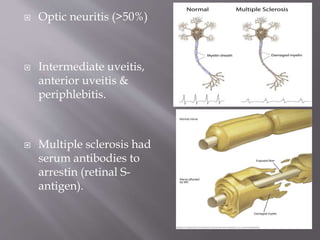  Optic neuritis (>50%)
 Intermediate uveitis,
anterior uveitis &
periphlebitis.
 Multiple sclerosis had
serum antibodies to
arrestin (retinal S-
antigen).
 