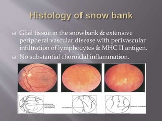  Glial tissue in the snowbank & extensive
peripheral vascular disease with perivascular
infiltration of lymphocytes & MHC II antigen.
 No substantial choroidal inflammation.
 