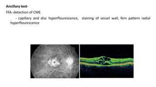 Ancillary test-
FFA- detection of CME
- capillary and disc hyperflourescence, staining of vessel wall, fern pattern radial
hyperflourescence
 