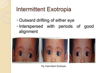Intermittent Xt Intermittent Xt