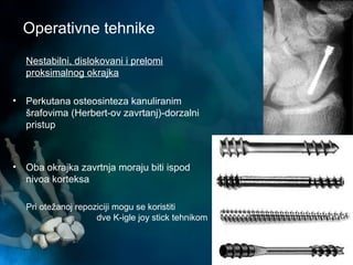 Operativne tehnike
Nestabilni, dislokovani i prelomi
proksimalnog okrajka
• Perkutana osteosinteza kanuliranim
šrafovima (Herbert-ov zavrtanj)-dorzalni
pristup
• Oba okrajka zavrtnja moraju biti ispod
nivoa korteksa
Pri otežanoj repoziciji mogu se koristiti
dve K-igle joy stick tehnikom
 
