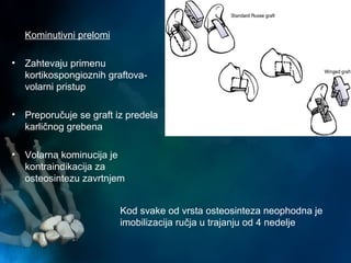 Kod svake od vrsta osteosinteza neophodna je
imobilizacija ručja u trajanju od 4 nedelje
Kominutivni prelomi
• Zahtevaju primenu
kortikospongioznih graftova-
volarni pristup
• Preporučuje se graft iz predela
karličnog grebena
• Volarna kominucija je
kontraindikacija za
osteosintezu zavrtnjem
 