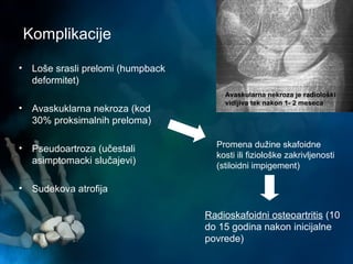 Komplikacije
• Loše srasli prelomi (humpback
deformitet)
• Avaskuklarna nekroza (kod
30% proksimalnih preloma)
• Pseudoartroza (učestali
asimptomacki slučajevi)
• Sudekova atrofija
Radioskafoidni osteoartritis (10
do 15 godina nakon inicijalne
povrede)
Avaskularna nekroza je radiološki
vidljiva tek nakon 1- 2 meseca
Promena dužine skafoidne
kosti ili fiziološke zakrivljenosti
(stiloidni impigement)
 