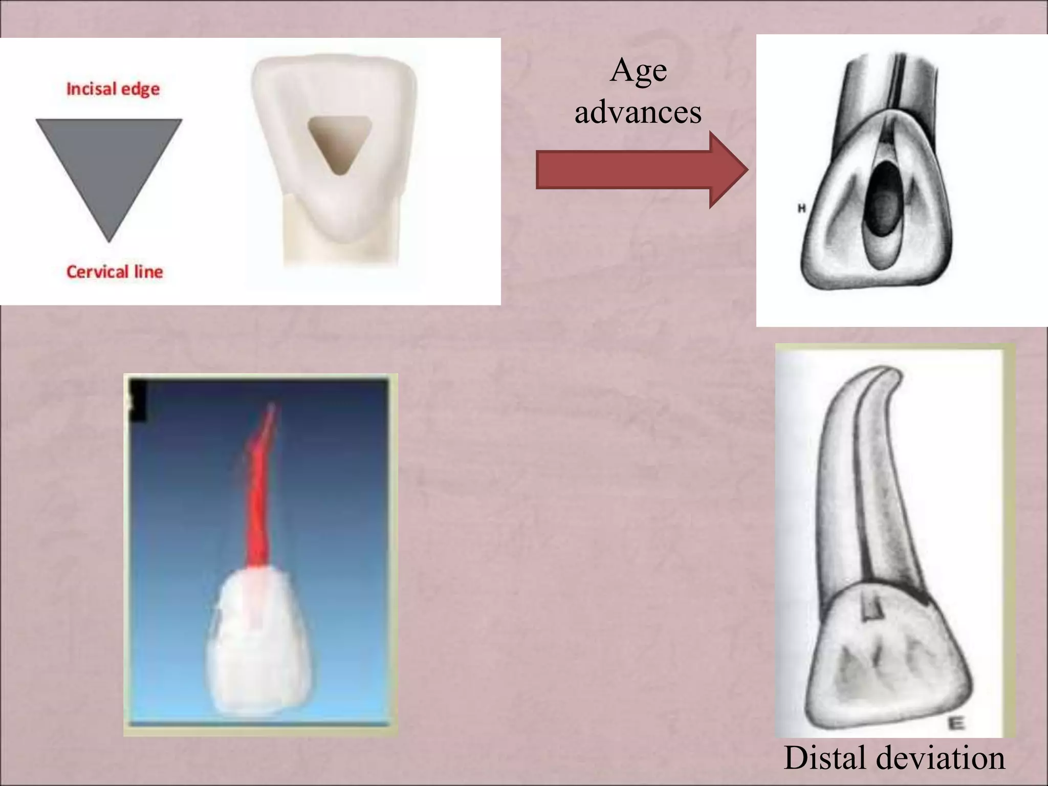 Age
advances
Distal deviation
 