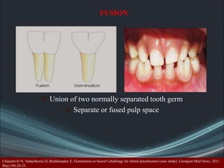 Pulp Space Injection Internal anatomy of pulp space | PPT