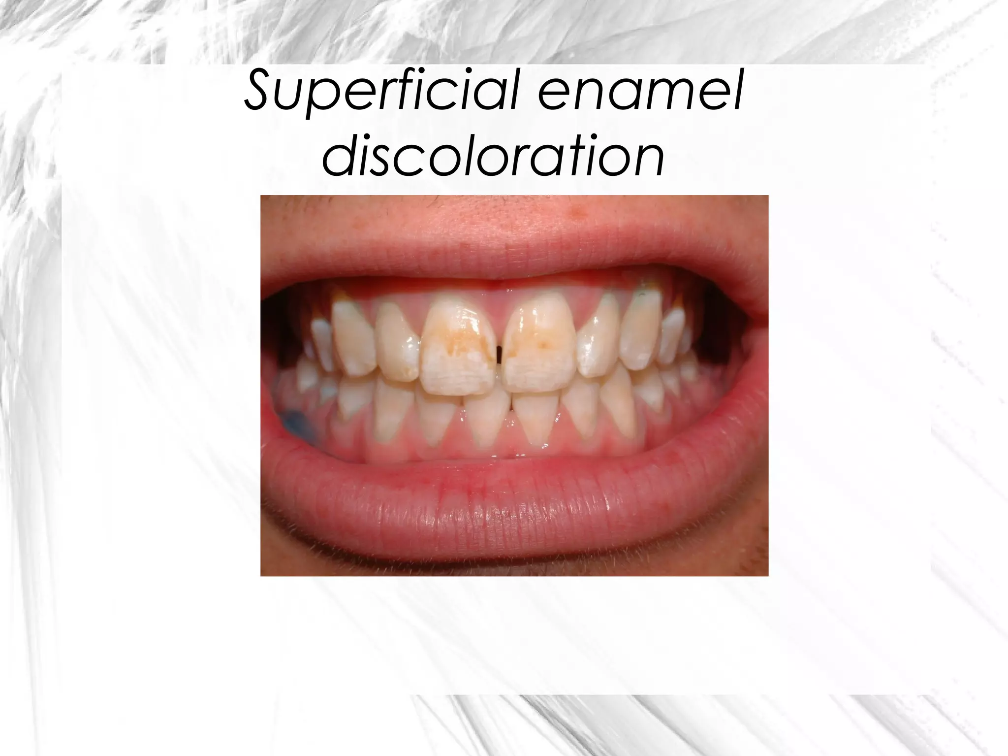 Superficial enamel
discoloration

 