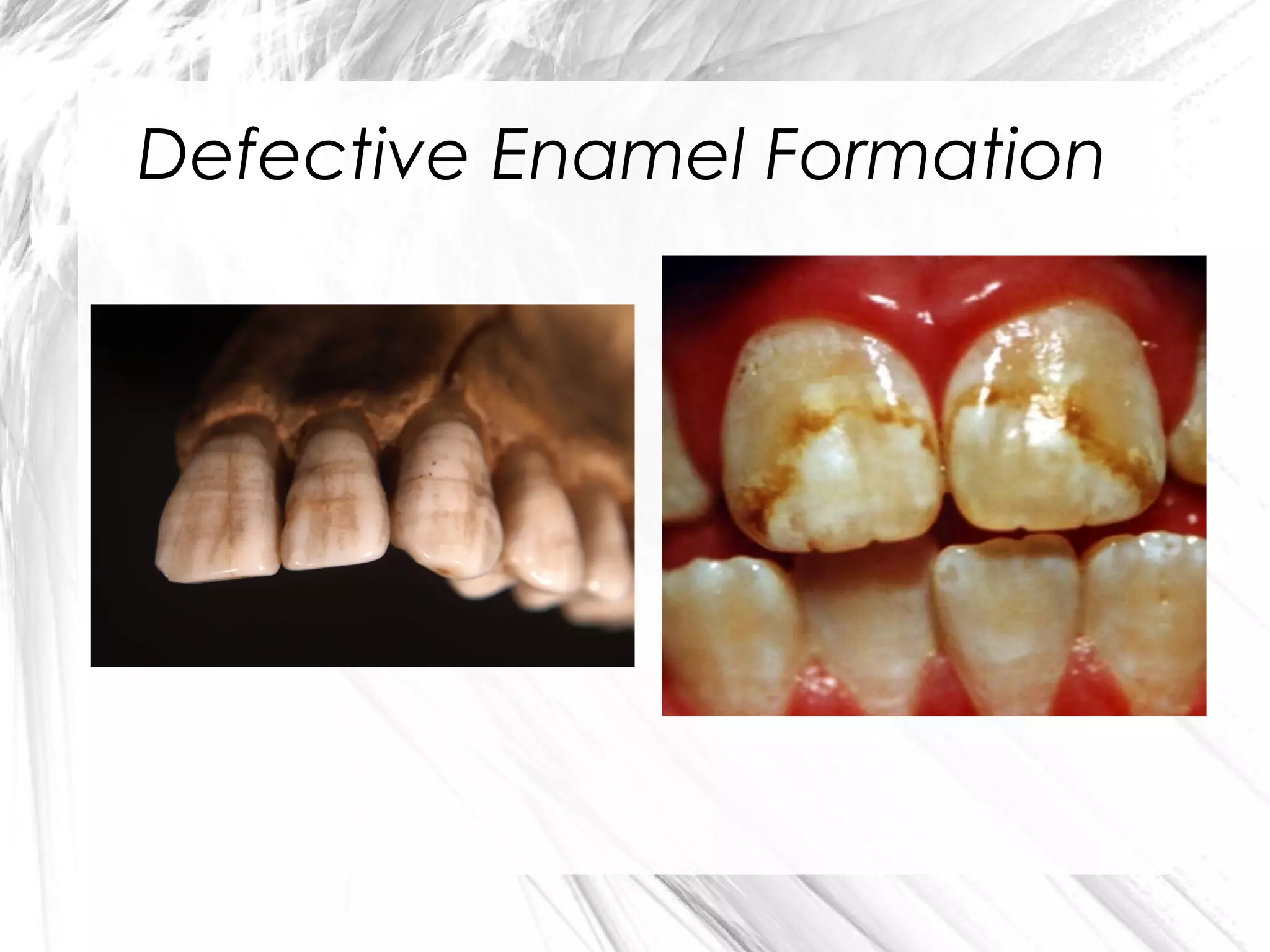 Defective Enamel Formation

 