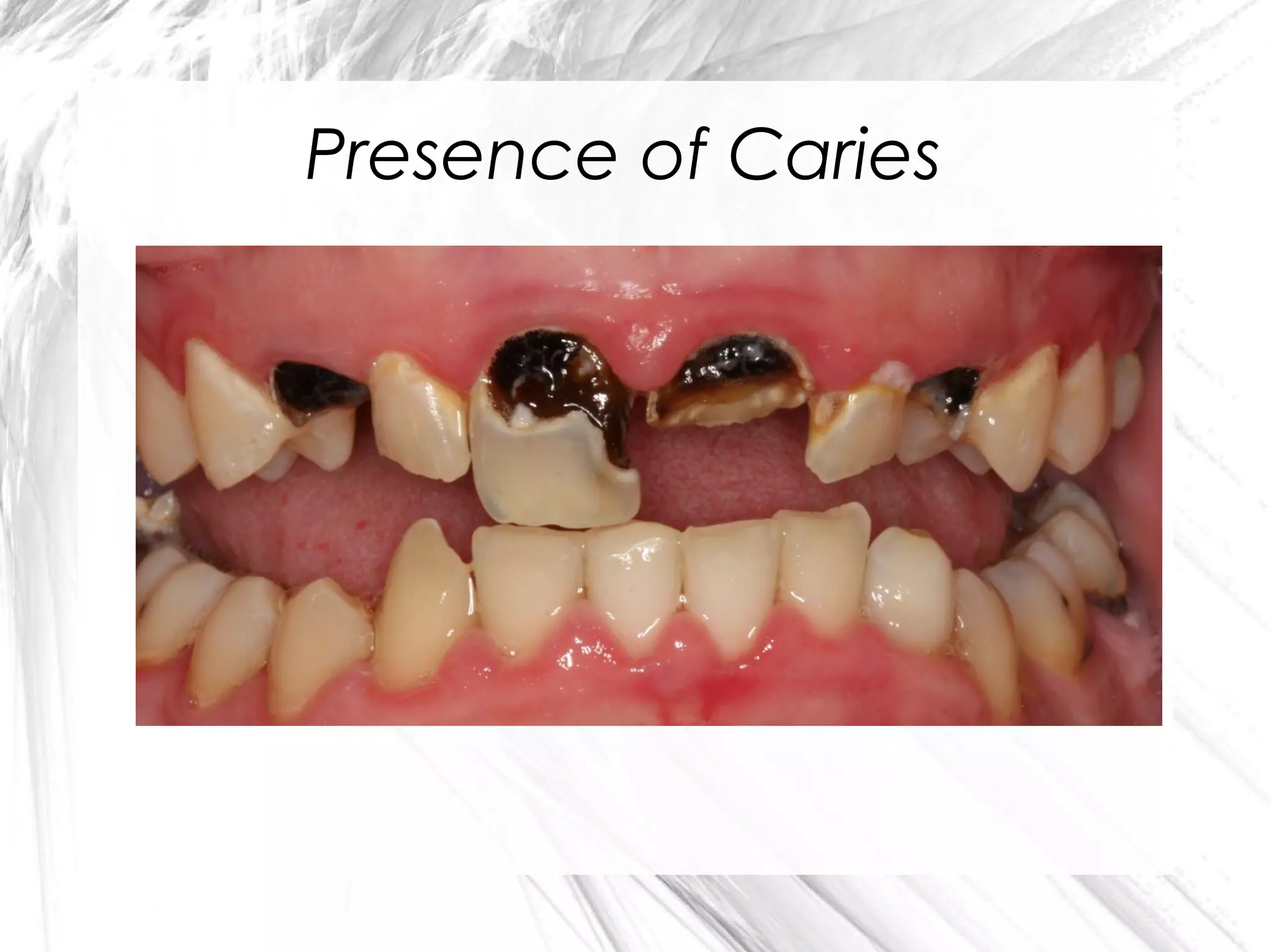 Presence of Caries

 