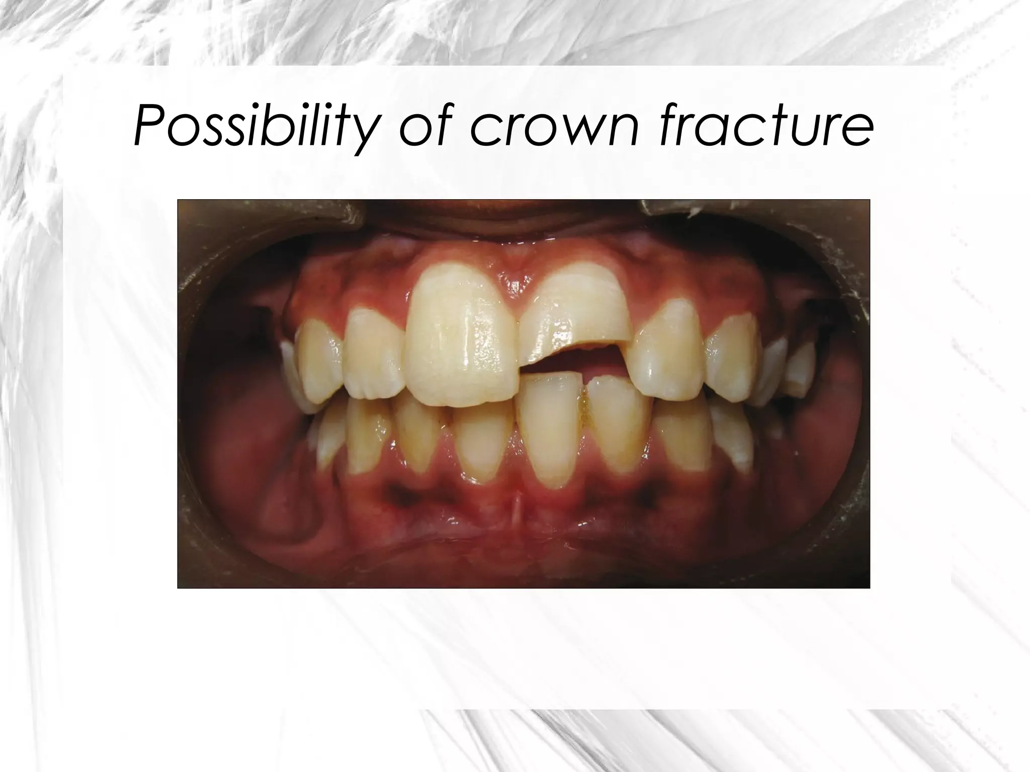 Possibility of crown fracture

 
