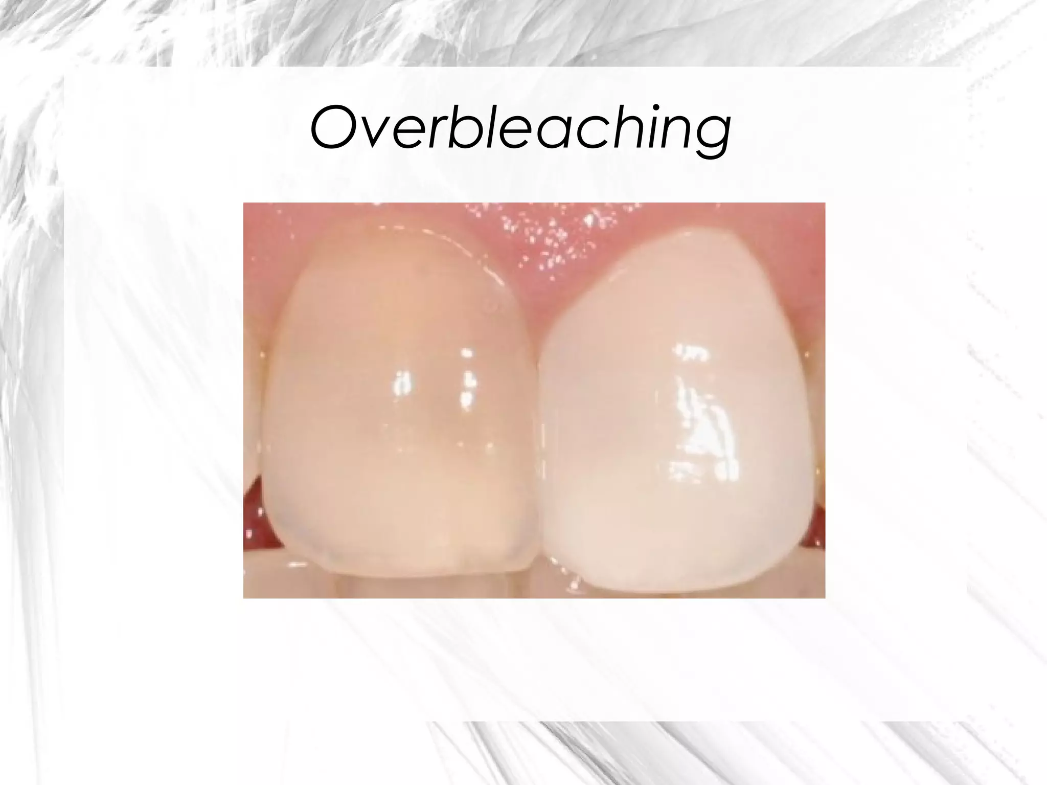Overbleaching

 