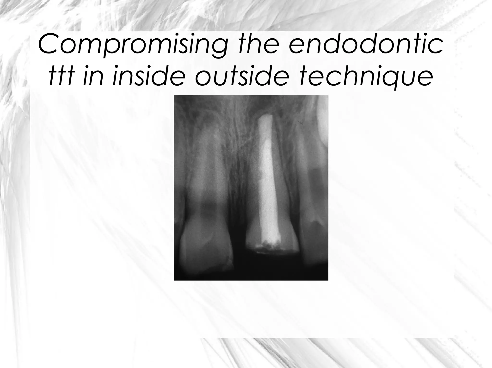 Compromising the endodontic
ttt in inside outside technique

 