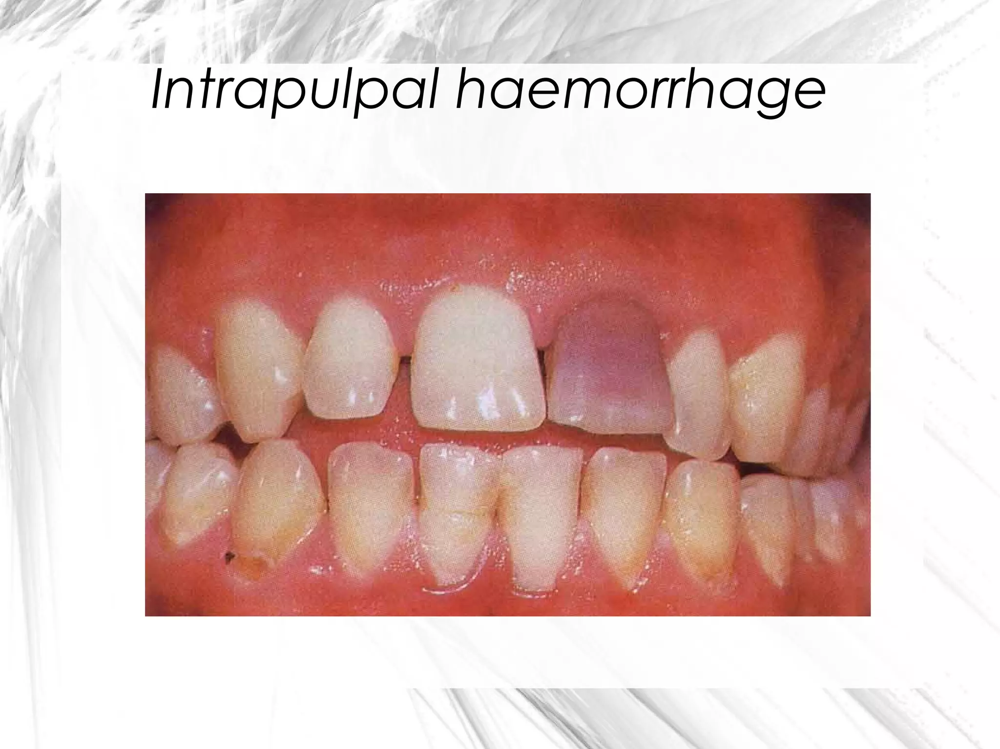 Intrapulpal haemorrhage

 