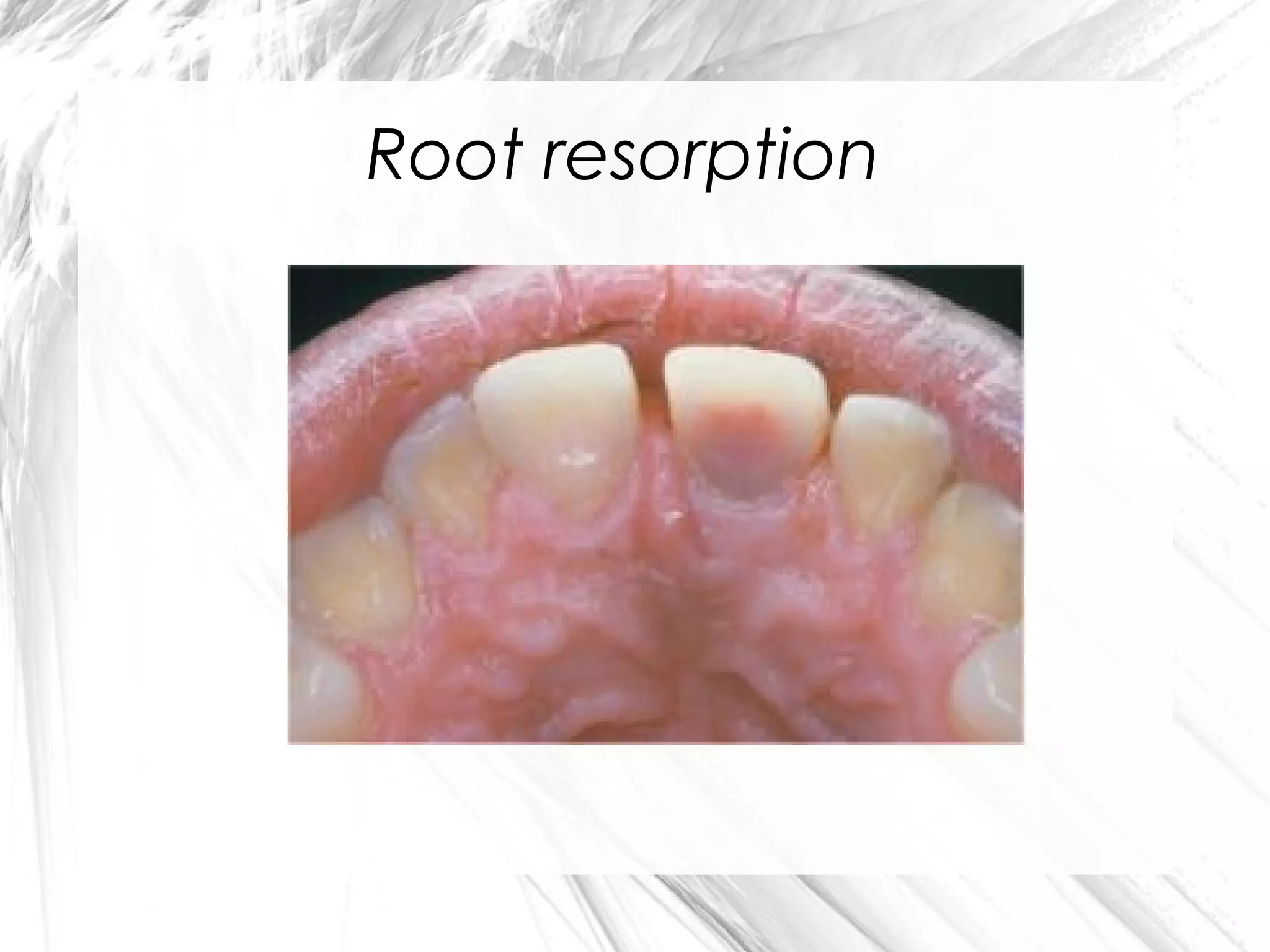 Root resorption

 