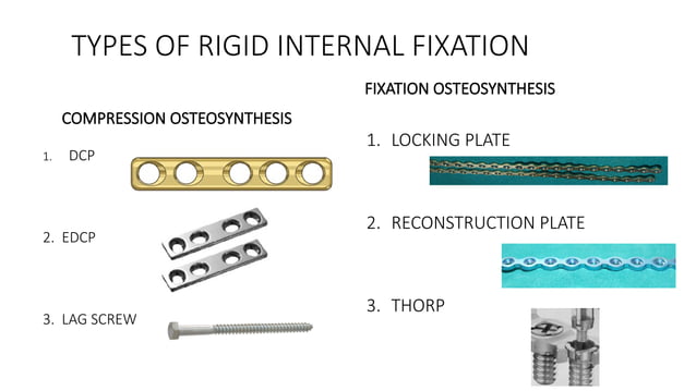 INTERNAL FIXATION IN MAXILLOFACIAL TRAUMA- PART A [Autosaved].pptx