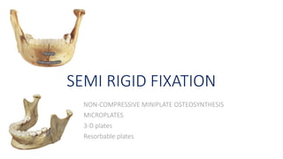 INTERNAL FIXATION IN MAXILLOFACIAL TRAUMA- PART A [Autosaved].pptx
