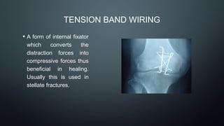 TENSION BAND WIRING
• A form of internal fixator
which converts the
distraction forces into
compressive forces thus
beneficial in healing.
Usually this is used in
stellate fractures.
 