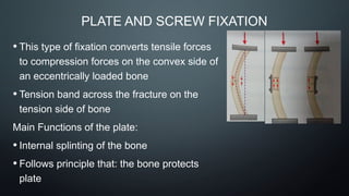 PLATE AND SCREW FIXATION
• This type of fixation converts tensile forces
to compression forces on the convex side of
an eccentrically loaded bone
• Tension band across the fracture on the
tension side of bone
Main Functions of the plate:
• Internal splinting of the bone
• Follows principle that: the bone protects
plate
 