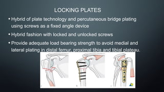 LOCKING PLATES
• Hybrid of plate technology and percutaneous bridge plating
using screws as a fixed angle device
• Hybrid fashion with locked and unlocked screws
• Provide adequate load bearing strength to avoid medial and
lateral plating in distal femur, proximal tibia and tibial plateau.
 