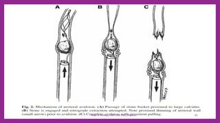 COMPLICATIONS OF URETEROSCOPY & ITS MANAGEMENT | PDF