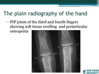 Internal Medicine Topic 9 OA and RA.pptx
