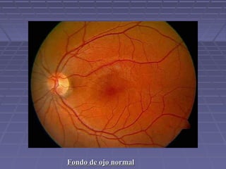 Fondo de ojo normalFondo de ojo normal
 