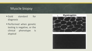 Muscle biopsy
 Gold standard for
diagnosis
 Performed when genetic
testing is negative, or the
clinical phenotype is
atypical
 
