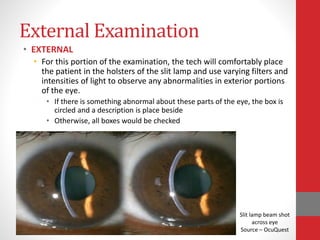External Examination
• EXTERNAL
• For this portion of the examination, the tech will comfortably place
the patient in the holsters of the slit lamp and use varying filters and
intensities of light to observe any abnormalities in exterior portions
of the eye.
• If there is something abnormal about these parts of the eye, the box is
circled and a description is place beside
• Otherwise, all boxes would be checked
Slit lamp beam shot
across eye
Source – OcuQuest
 